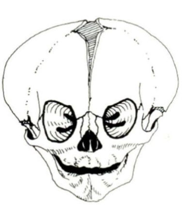 Drawing of Brachycephaly image credit - Geneva Foundation for Medical Education and Research