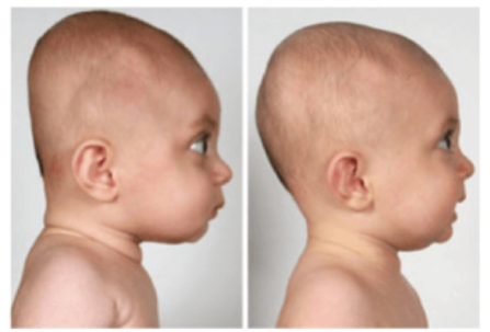 Example of Flat Head Syndrome and a normal skull compared to flat shape of the Starchild Skull