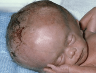 Examples of Hydrocephaly